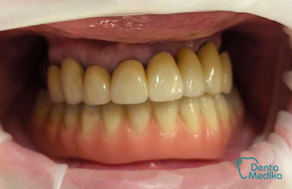 Třmenová hybridní náhrada na implantátech pro bezzubou čelist 8